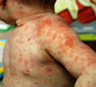 <b>Stevens Johnson Syndrome</b>: The