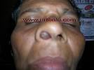 Proptosis if lamina papyracea is breached. Patient with inverted papilloma ... - papi_nose
