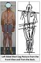 Anatomic <b>leg length inequality</b>