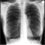<b>Alpha</b>-<b>1</b>-<b>antitrypsin deficiency</b>