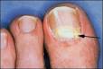 <b>onychomycosis</b>(arrow).