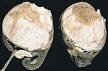 <b>Wilms</b>' <b>tumor</b>