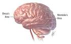 What is <b>Aphasia</b>? | Internet Stroke Center