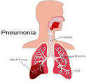 Pneumonia | Dr. B C Shah