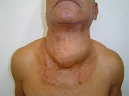 Thyroid Cancers