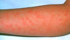 Scarlet fever is a bacterial
