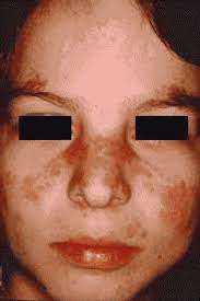 Lupus Picture