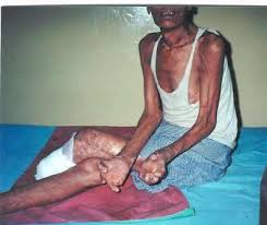 Leprosy