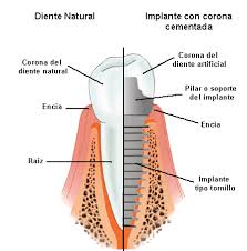 implante vs diente Coronas y puentes fijos