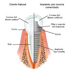 Has perdido dientes? Ayuda implante vs diente Has perdido dientes? Ayuda