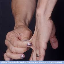 People with Ehlers-Danlos