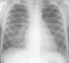 There is pulmonary venous