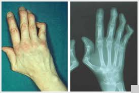 Lupus Symptoms on Tendons