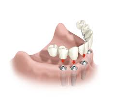 protesis total sobre implantes dentales Importancia del mantenimiento de los implantes
