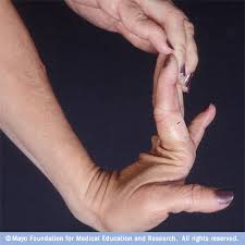 Ehlers-Danlos syndrome