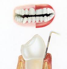 gingivitis Como empiezan los problemas dentales