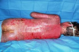 Stevens-Johnson syndrome.