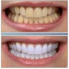 2B5329 1 ¿En qué consiste un tratamiento de blanqueamiento dental?