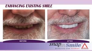 snap on smile 1