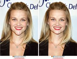 reese witherspoon surgery