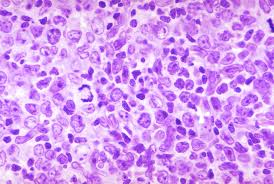 Diffuse lymphomas- again