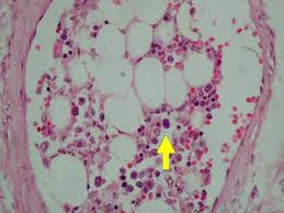 (Figure 3) Fat embolism with