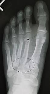 Lisfranc fracture demarcated