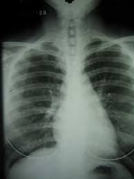 of Mesothelioma Lawsuit :