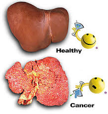 liver cancer