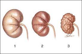 Acute renal failure; Normal