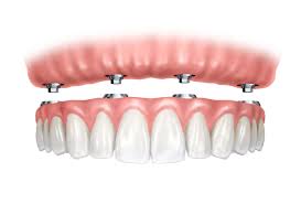 protesis dental total removible sobre implantes dentales precios Importancia del mantenimiento de los implantes