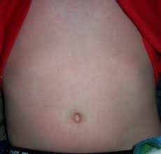 scarlet fever rash