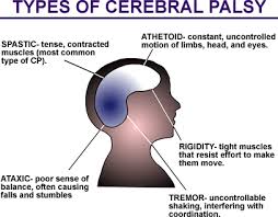 Cerebral Palsy: Our Brain