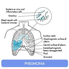Bronchitis and Pneumonia