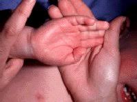 Lyme disease (borrelia