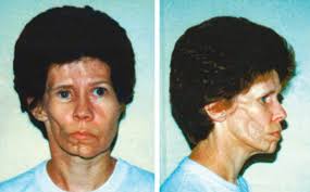 Parry Romberg syndrome.