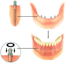 dental implants1 ¿Que ventajas tiene un implante?