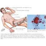 (Fat Embolism Syndrome)