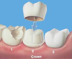 pictures tooth crown