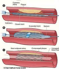 Stents, a Temporary Solution