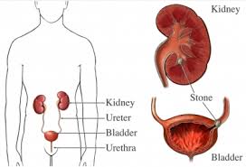 Renal Failure