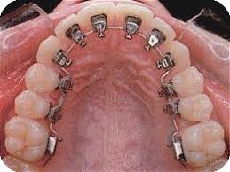 Lingual Braces