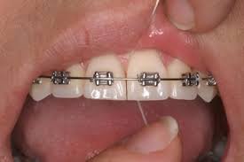 cepillado%252012 Utiliza el Hilo Dental