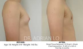 teen tit|Breast growth disorder harms teen girls' health | Fox News