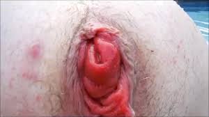 Total rectal prolapse porn open cunt png x Rectal prolapse