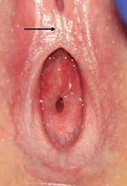 hymen child|Pediatric and Adolescent Gynecology | Obgyn Key