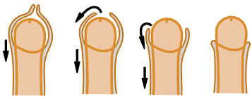 中学生包茎ちんこ|高校生の包茎とは？自然と改善？取れる選択肢と包茎の注意点のお話 - アトムクリニック - atom-clinic