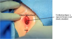 child hymen |The little tissue that couldn't – dispelling myths about the Hymen's role  in determining sexual history and assault | Reproductive Health | Full Text