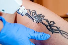 remove tattoo stock|482 Tattoo And Removal Stock Photos, High-Res Pictures, and Images - Getty  Images