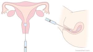 子宮口精子注射画像|選別精子子宮内注入法